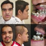Triple cirugía en el IMSS devuelve nueva vida a joven que sufrió años de rechazo social